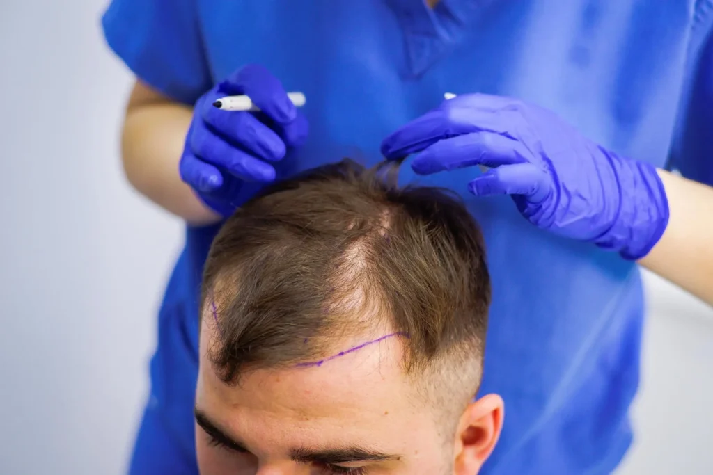 Where to Get Hair Transplant for Safe, Natural Results