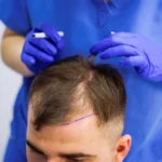 Where to Get Hair Transplant for Safe, Natural Results