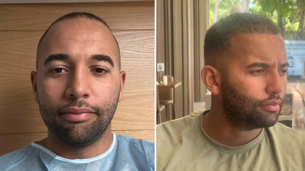 Afro Hair Transplant Recovery