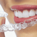 Aligners