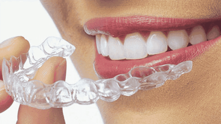Aligners