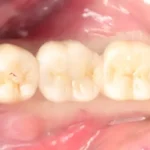 Implant Restoration: The Complete Guide to Rebuilding Smiles with Precision and Durability