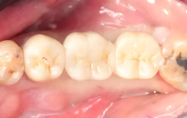 Implant Restoration: The Complete Guide to Rebuilding Smiles with Precision and Durability