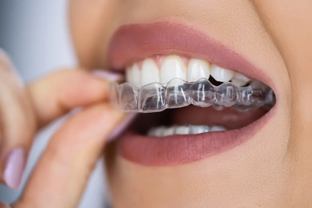 Aligner Treatment