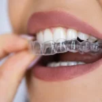 Aligner Treatment