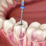 Endodontics