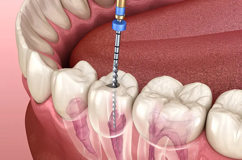 Endodontics