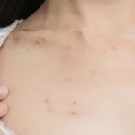 High-Risk Skin Warning Signs