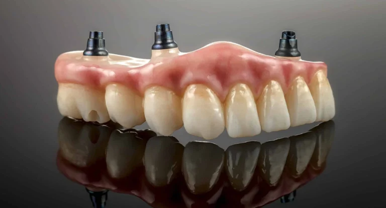 Implant Dentures