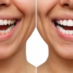 Cosmetic Tooth Contouring