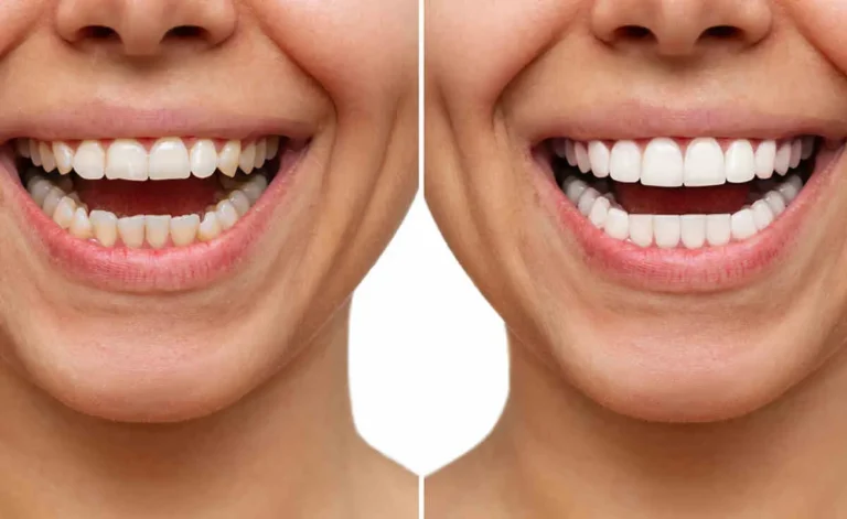 Cosmetic Tooth Contouring