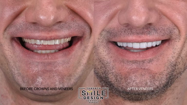 The Role Of Veneers In Cosmetic Smile Design