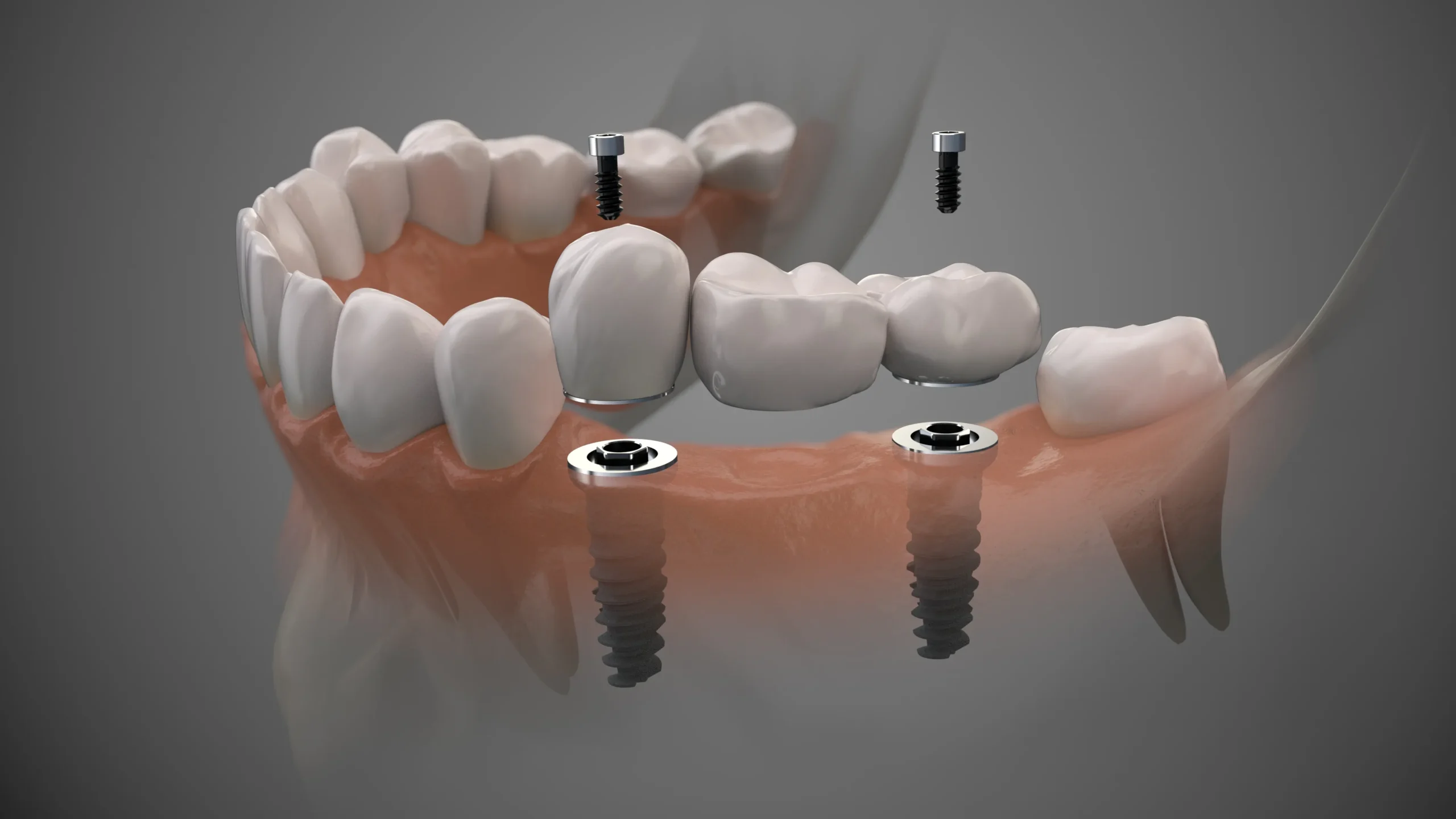The Real Reason Dental Implants Fail and How to Choose a Specialist Who Prevents It