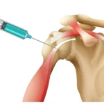 Can PRP Fix A Rotator Cuff Tear?