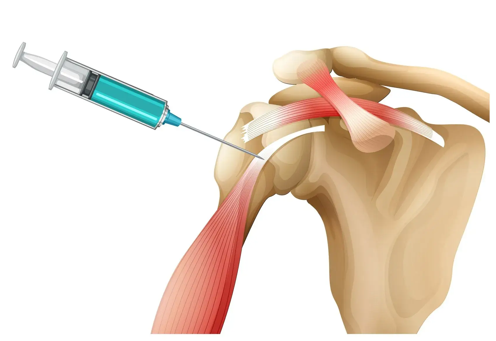Can PRP Fix A Rotator Cuff Tear?