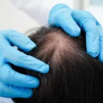 Understanding Hair Loss Treatment For Women In Florida Clinics