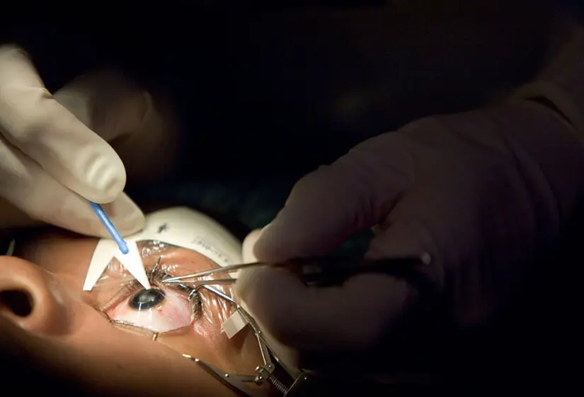 Inside the Surge in Refractive Surgery: What Clinics Need to Know